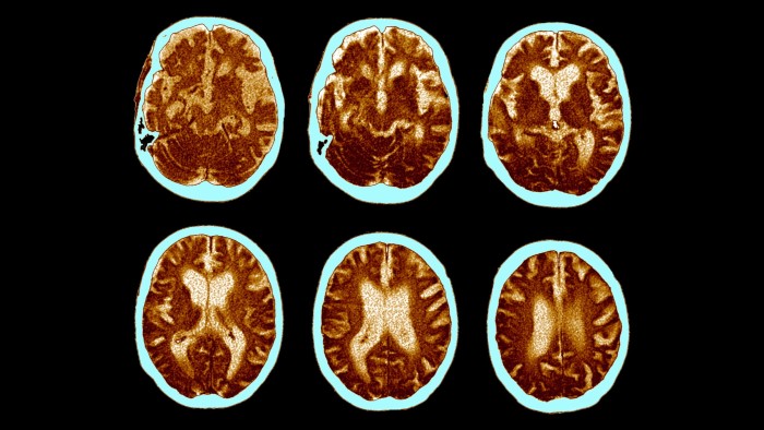 Les médicaments contre l’obésité peuvent-ils aider à traiter la maladie d’Alzheimer ?