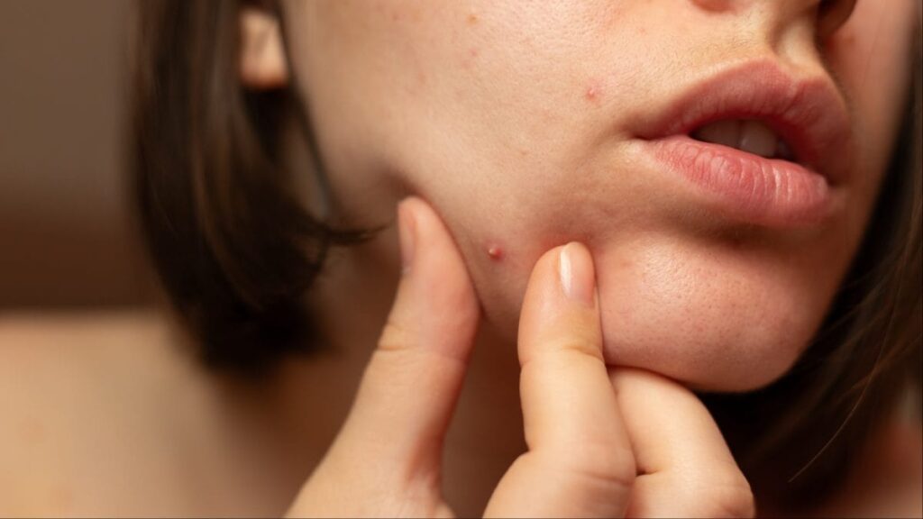 Au-delà de l’acné chez les adolescentes : comment le stress et le mode de vie sont à l’origine de l’acné chez les jeunes en Inde | Actualités beauté